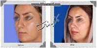 عمل بینی شماره 976