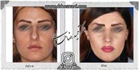 عمل بینی شماره 977