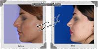 عمل بینی شماره 978