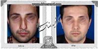 عمل بینی شماره 979