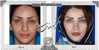 عمل بینی شماره 981