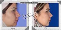عمل بینی شماره 986گوشتی