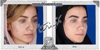 عمل بینی شماره 987غضروفی با پوست ضخیم