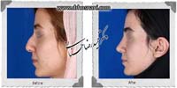 عمل بینی شماره 988غضروفی با پوست ضخیم