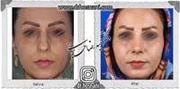 عمل بینی شماره 989غضروفی (استخوانی)