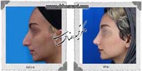 عمل بینی شماره 994