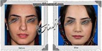 عمل بینی شماره 995