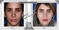 عمل بینی شماره 997