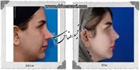 عمل بینی شماره 998