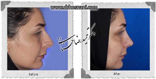 کاهش ارتفاع بینی