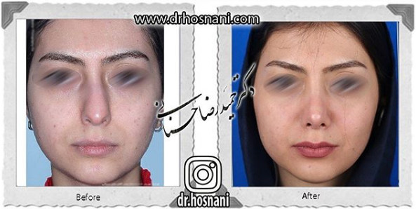 اصلاح انحراف بینی
