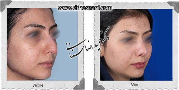 اصلاح انحراف بینی