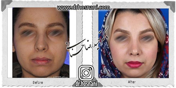 اصلاح انحراف بینی