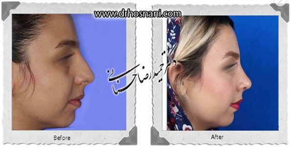 اصلاح انحراف بینی