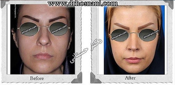 کاهش ارتفاع بینی