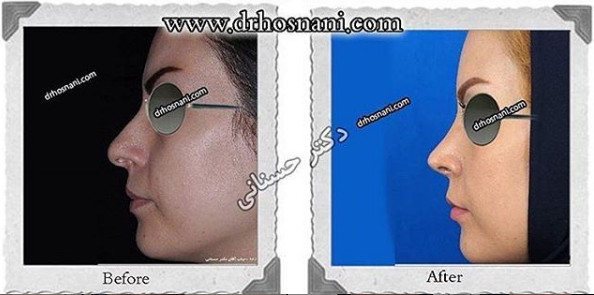 کاهش ارتفاع بینی