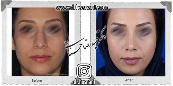 جراحی بینی