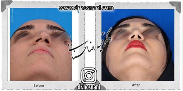 اصلاح انحراف بینی
