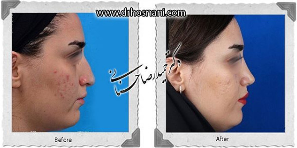 اصلاح انحراف بینی