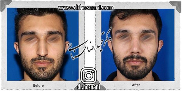 جراحی بینی
