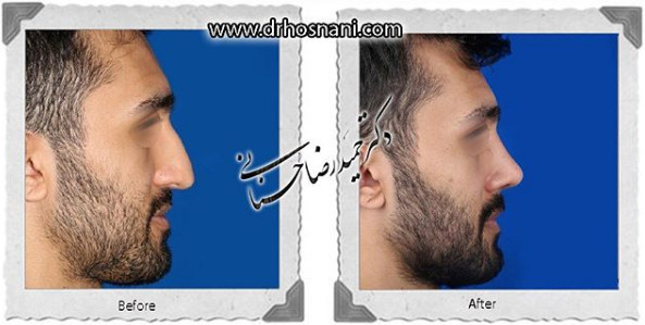 جراحی بینی