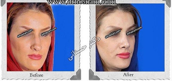  جراحی بینی -1015