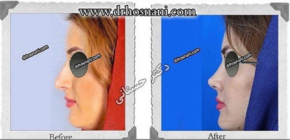  جراحی بینی -1016