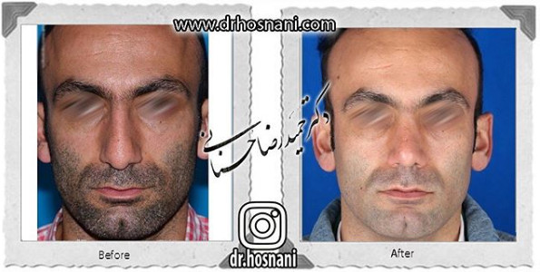 جراحی بینی