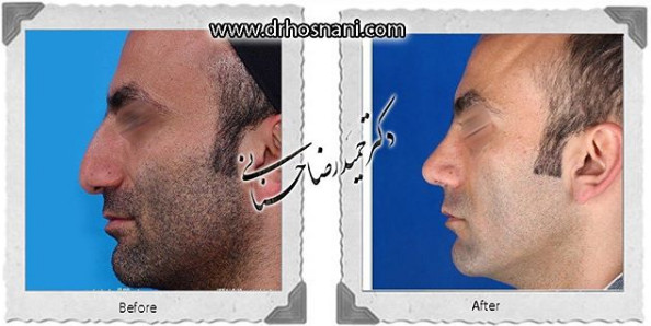  جراحی بینی -1022
