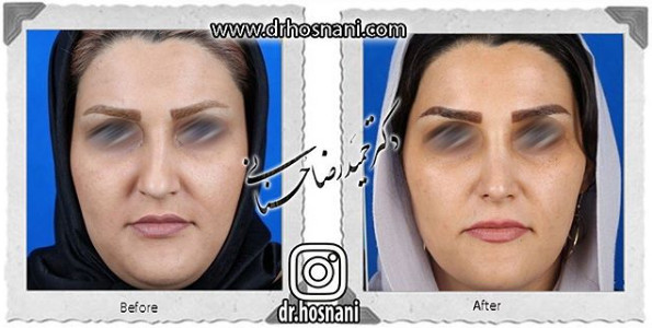 جراحی بینی