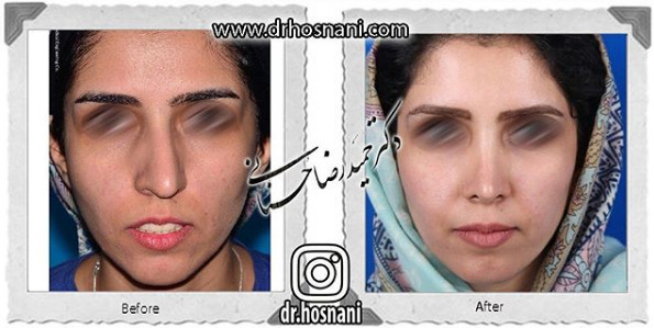 اصلاح انحراف بینی