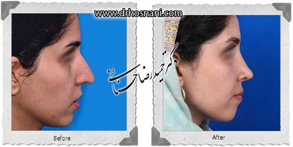 اصلاح انحراف بینی