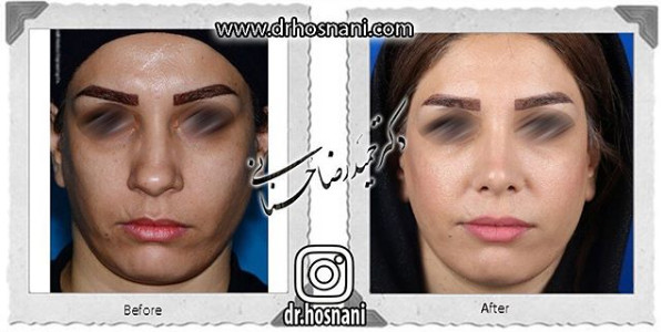 اصلاح انحراف بینی