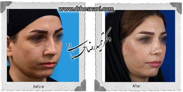 اصلاح انحراف بینی