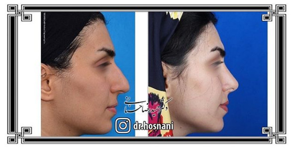 جراحی بینی