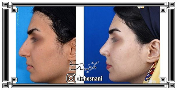جراحی بینی
