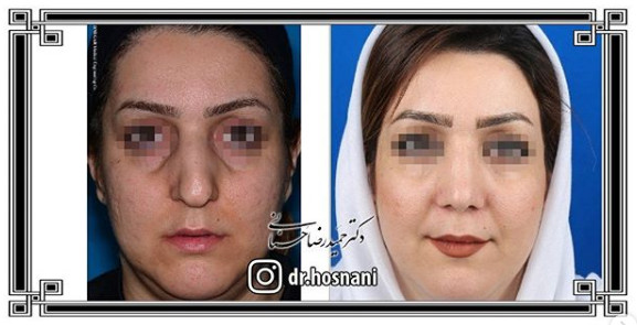 اصلاح انحراف بینی