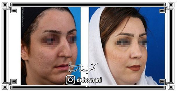 اصلاح انحراف بینی