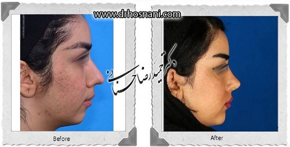 جراحی بینی