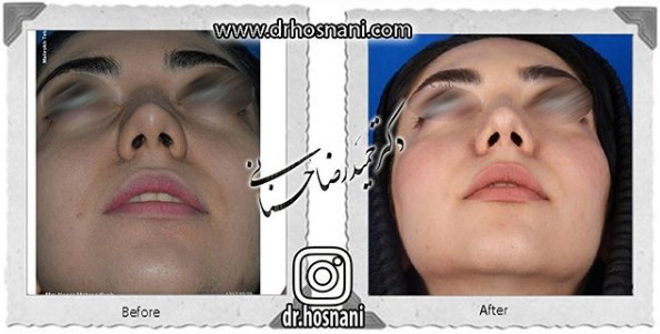  جراحی بینی -1035