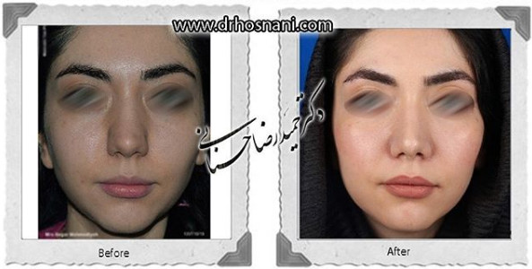  جراحی بینی -1036