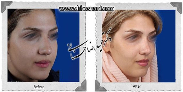  جراحی بینی -1038