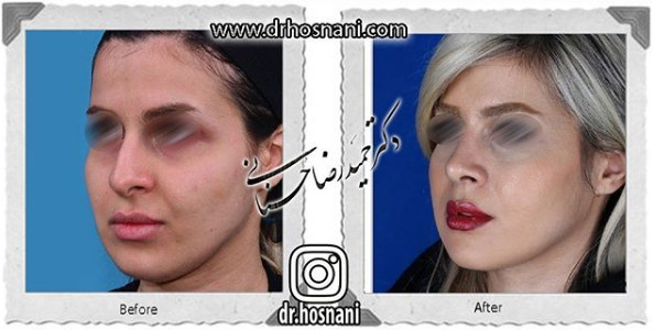  جراحی بینی -1039