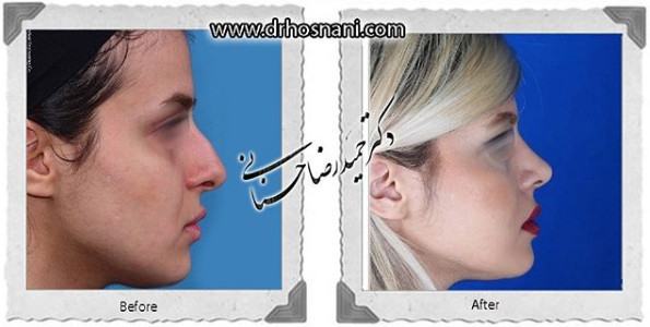  جراحی بینی -1040