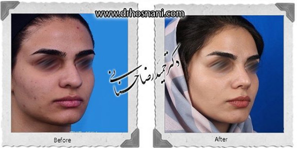  جراحی بینی -1042