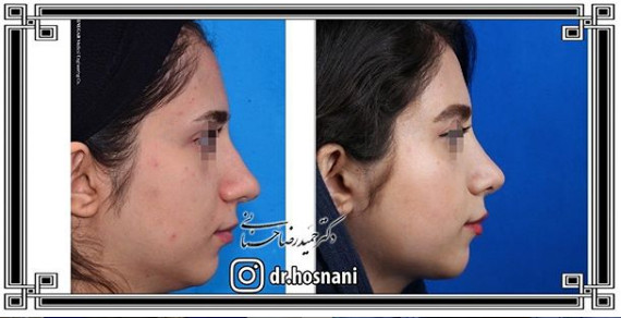  جراحی بینی -1044
