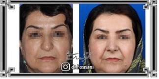  جراحی بینی -1047