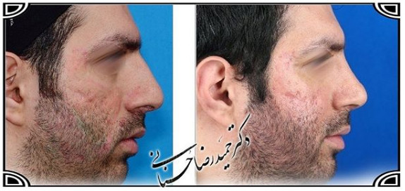  جراحی بینی -1050