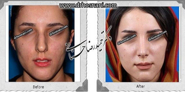 جراحی بینی