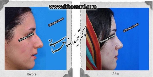  جراحی بینی -1052